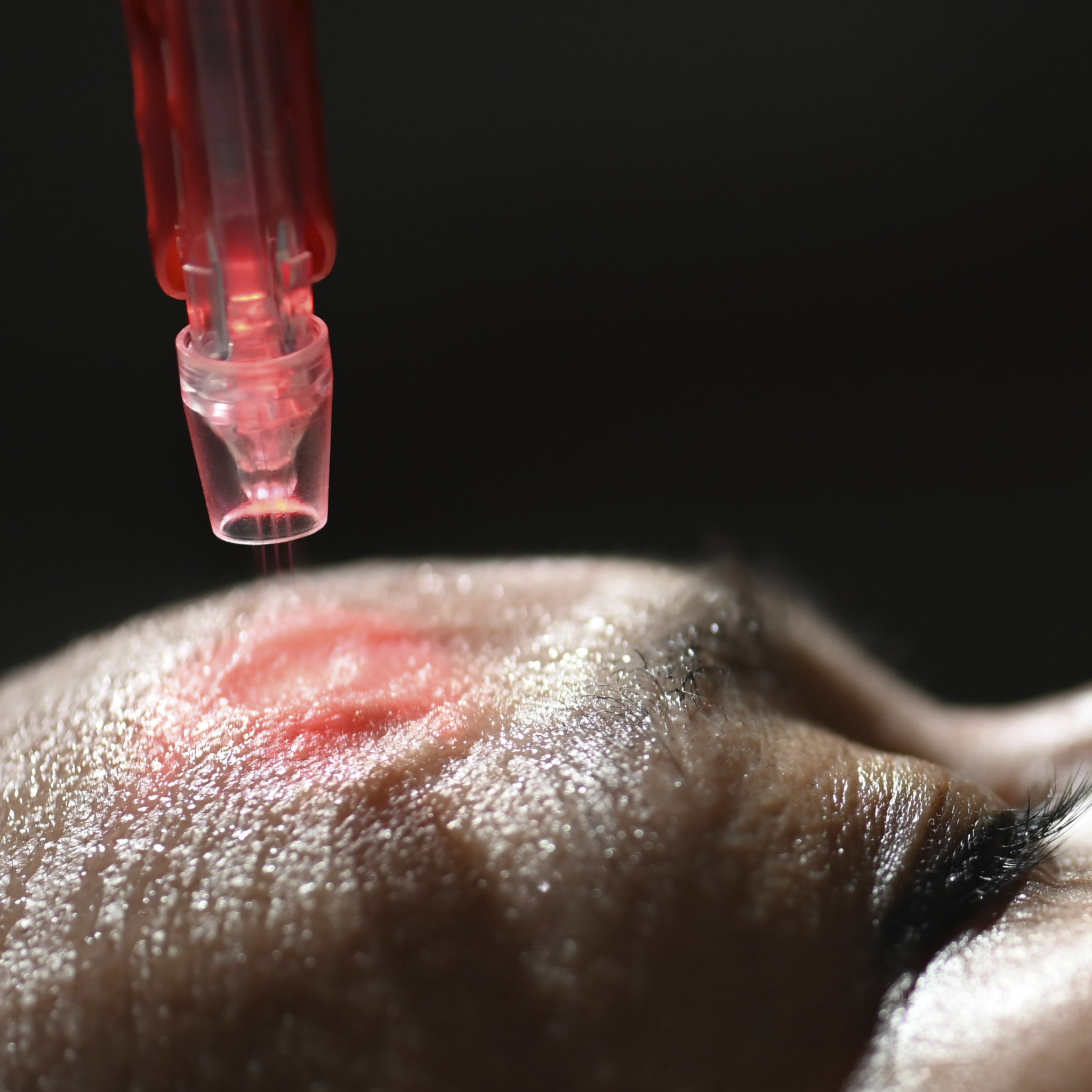 Jet Peeling an der Stirne zum Falten entfernen.